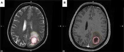 Association of Isocitrate Dehydrogenase (IDH) Status With Edema to Tumor Ratio and Its Correlation With Immune Infiltration in Glioblastoma